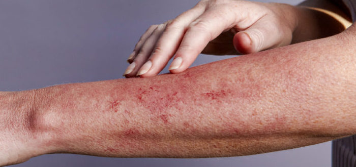 ما هي أعراض نقص المناعة على الجلد؟