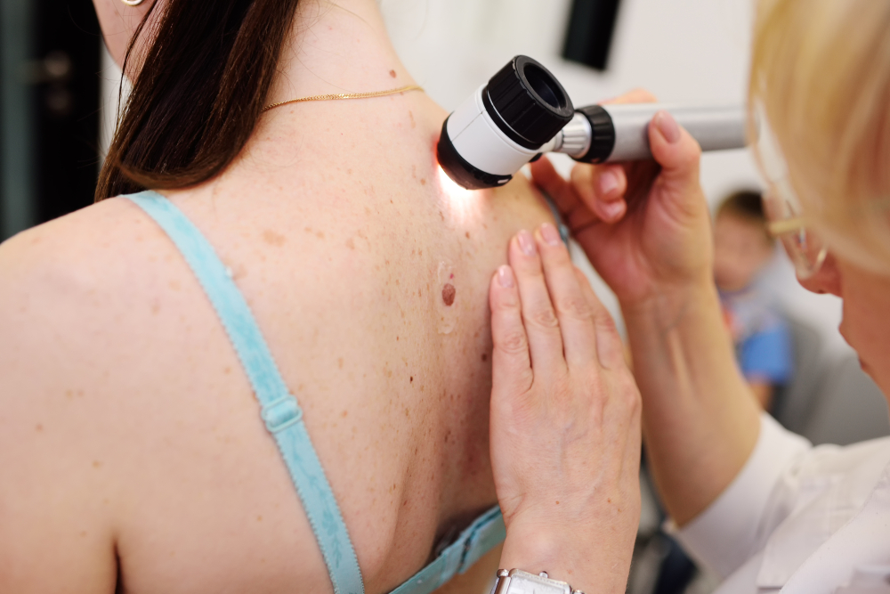 ما هي اعراض سرطان الجلد وطريقة التشخيص؟