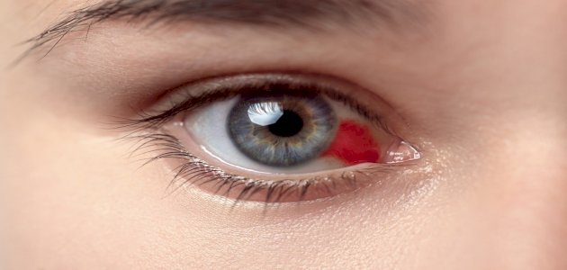 أسباب ظهور نقطة دم في العين