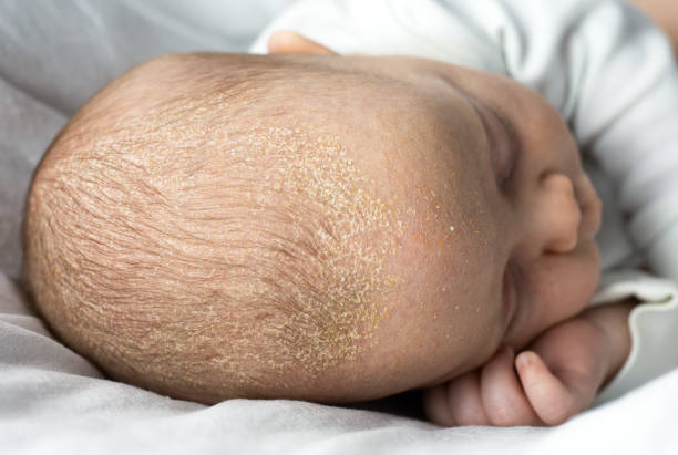 قشرة رأس الرضيع: أسبابها وأعراضها