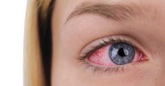 تمييز الفرق بين التهاب العين الفيروسي والبكتيري
