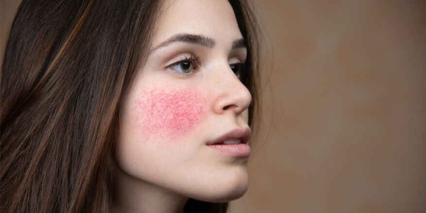 كيف يمكن التخلص من آثار الكورتيزون على الوجه؟