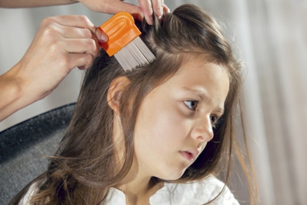 علاجات منزلية لقمل الرأس عند الأطفال