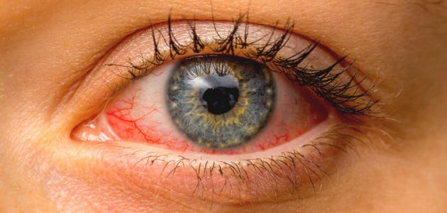 أمراض العيون بالصور التوضيحية