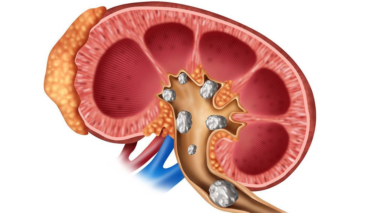 ما هي اعراض حصى الكلى