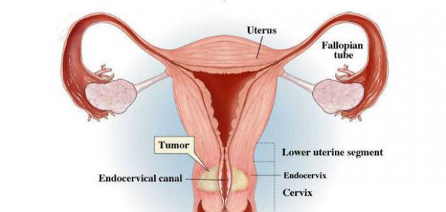 اعراض سرطان المهبل وعنق الرحم