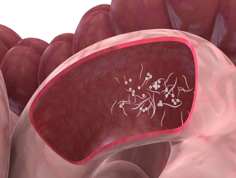 أسباب الدود الابيض في البراز وأعراضه وعلاجه
