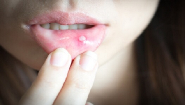 علاج الحمو في الفم بالطرق الطبية والطبيعية