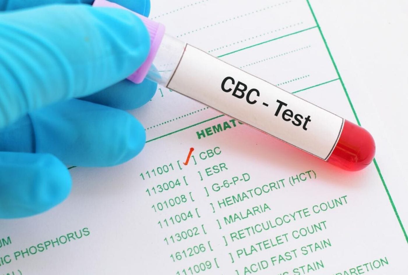 هل تحليل cbc يكشف سرطان الغدد اللمفاوية