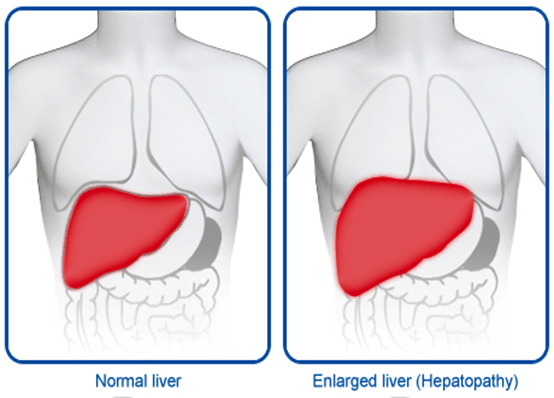 ما هي اسباب تضخم الكبد؟
