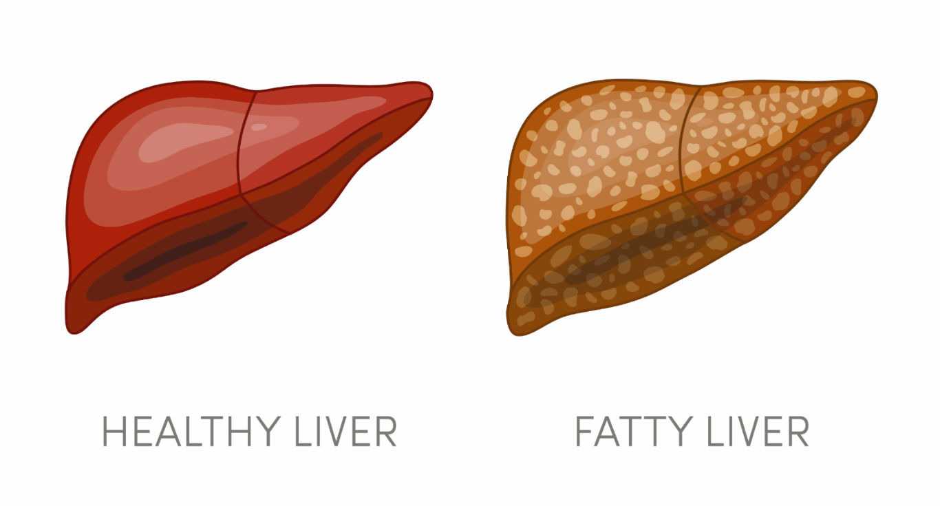 أعراض مرض الكبد الدهني