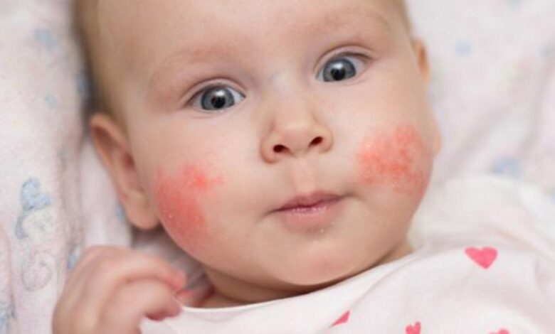 كريم حساسية الوجه للاطفال الرضع
