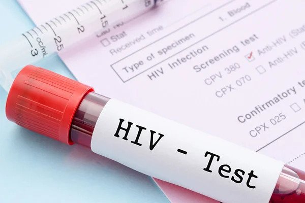 متى يظهر مرض الإيدز بتحليل الدم؟