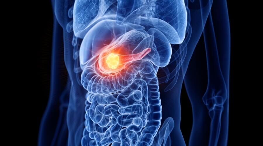 ما هي أهم أعراض سرطان البنكرياس المرحلة الأخيرة؟