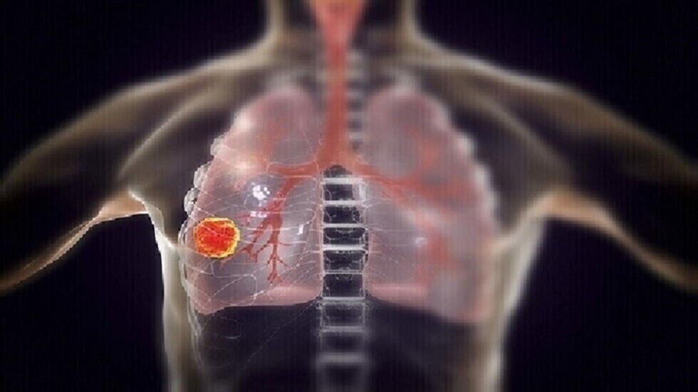 أعراض سرطان الرئة المتأخر