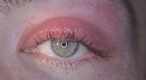 ما أسباب التهاب جفن العين؟