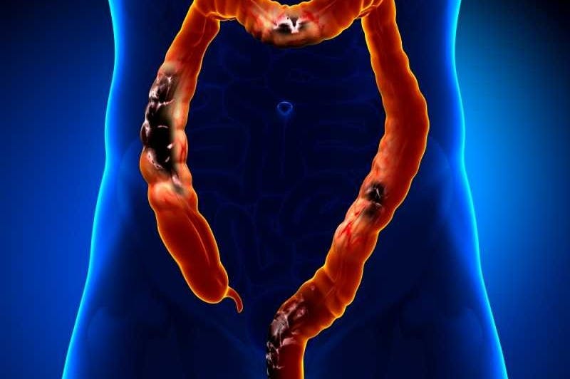 سرطان القولون المنتشر في الكبد والرئة