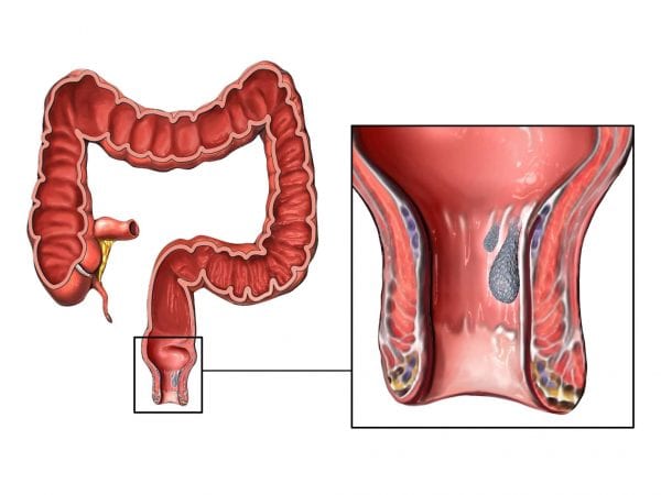 علاج خروج الدم من الدبر بالأعشاب