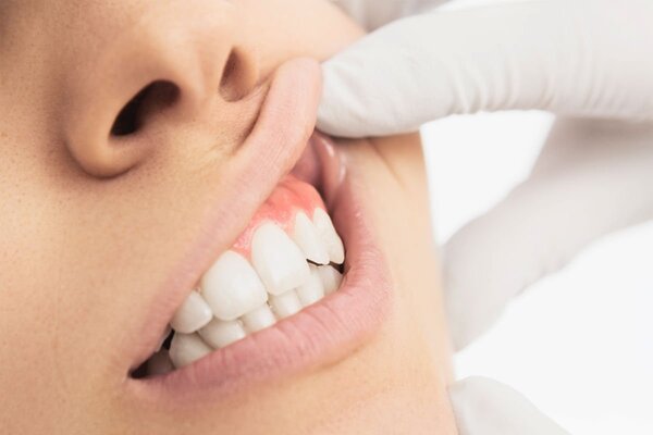 كيف يمكن علاج نزول اللثة وتعري الأسنان؟