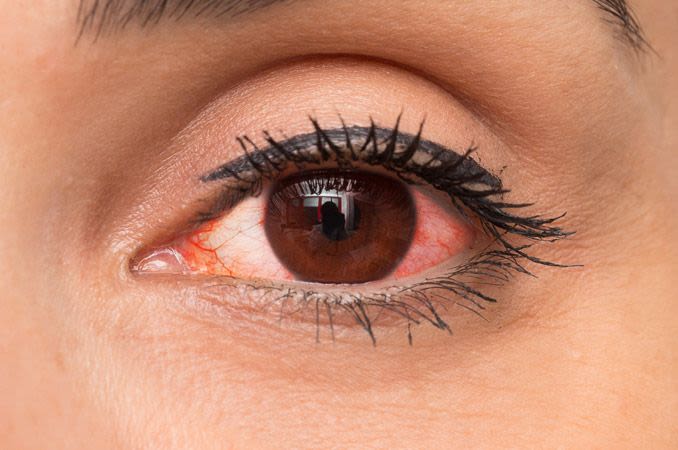 هل ظهور عروق حمراء في العين من علامات الحمل؟