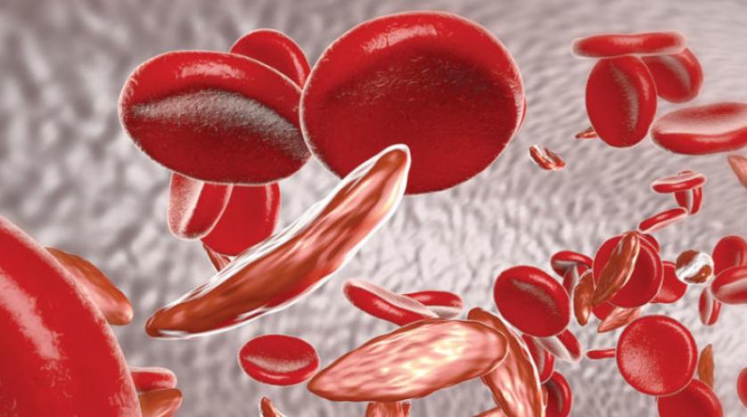 ما هو فقر الدم المنجلي وما أسباب حدوثه؟