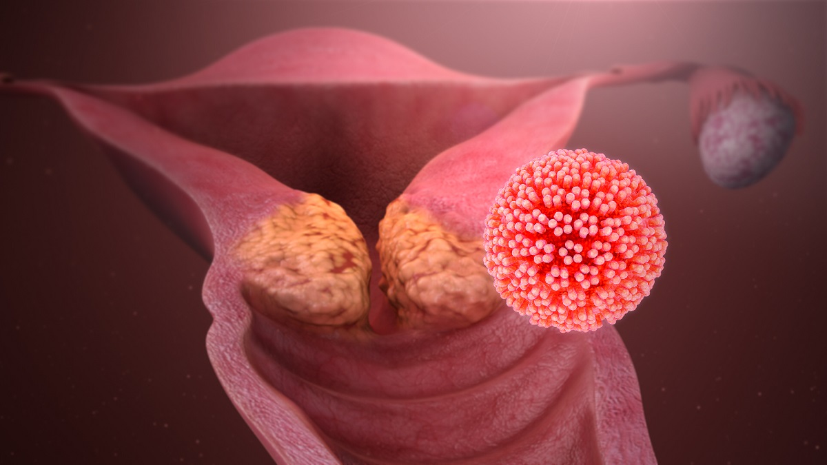 ما هي نسبة الشفاء من سرطان عنق الرحم؟