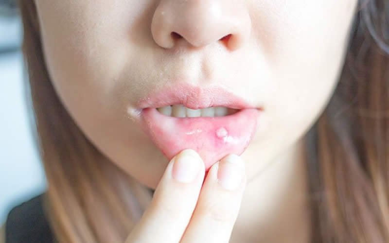 متى تكون حبوب الفم خطيرة؟
