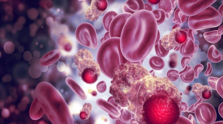 ما هي مراحل سرطان الدم؟