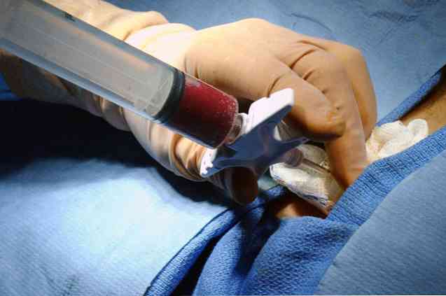 ما هي نسبة نجاح عملية زرع النخاع لمرضى سرطان الدم؟