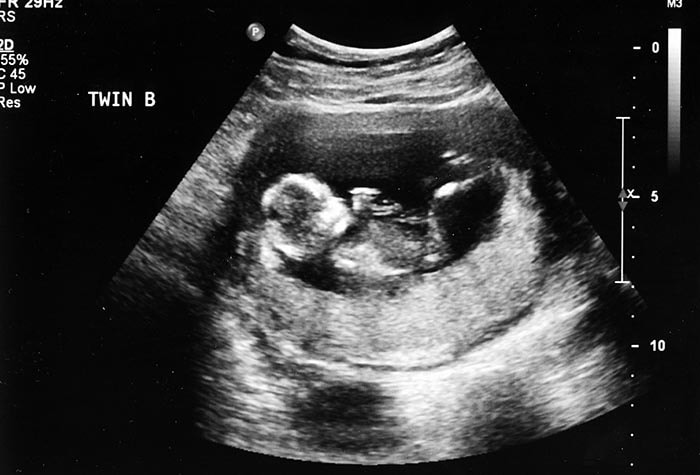 هل السونار يخطئ في تحديد نوع الجنين في الشهر الخامس؟