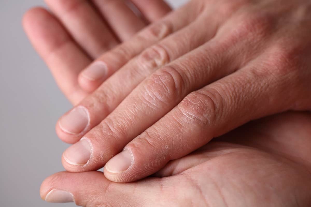 هل تقشر اليدين نقص فيتامين؟