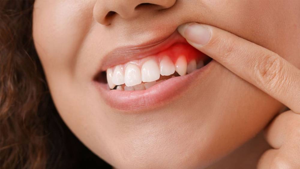كيف يمكن علاج التهاب اللثة بعد زراعة الأسنان؟