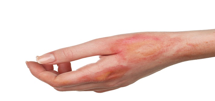 أعراض ظهور بقع على الجلد تشبه الحروق وعلاجه