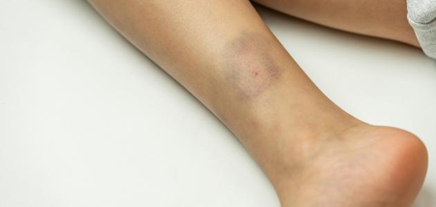 عوامل ظهور كدمات في الساق بدون سبب