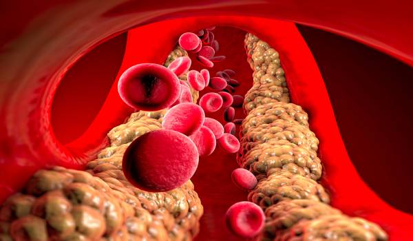 كيفية علاج الدهون الثلاثية والكلسترول وتصلب الشرايين خلال اسبوعين