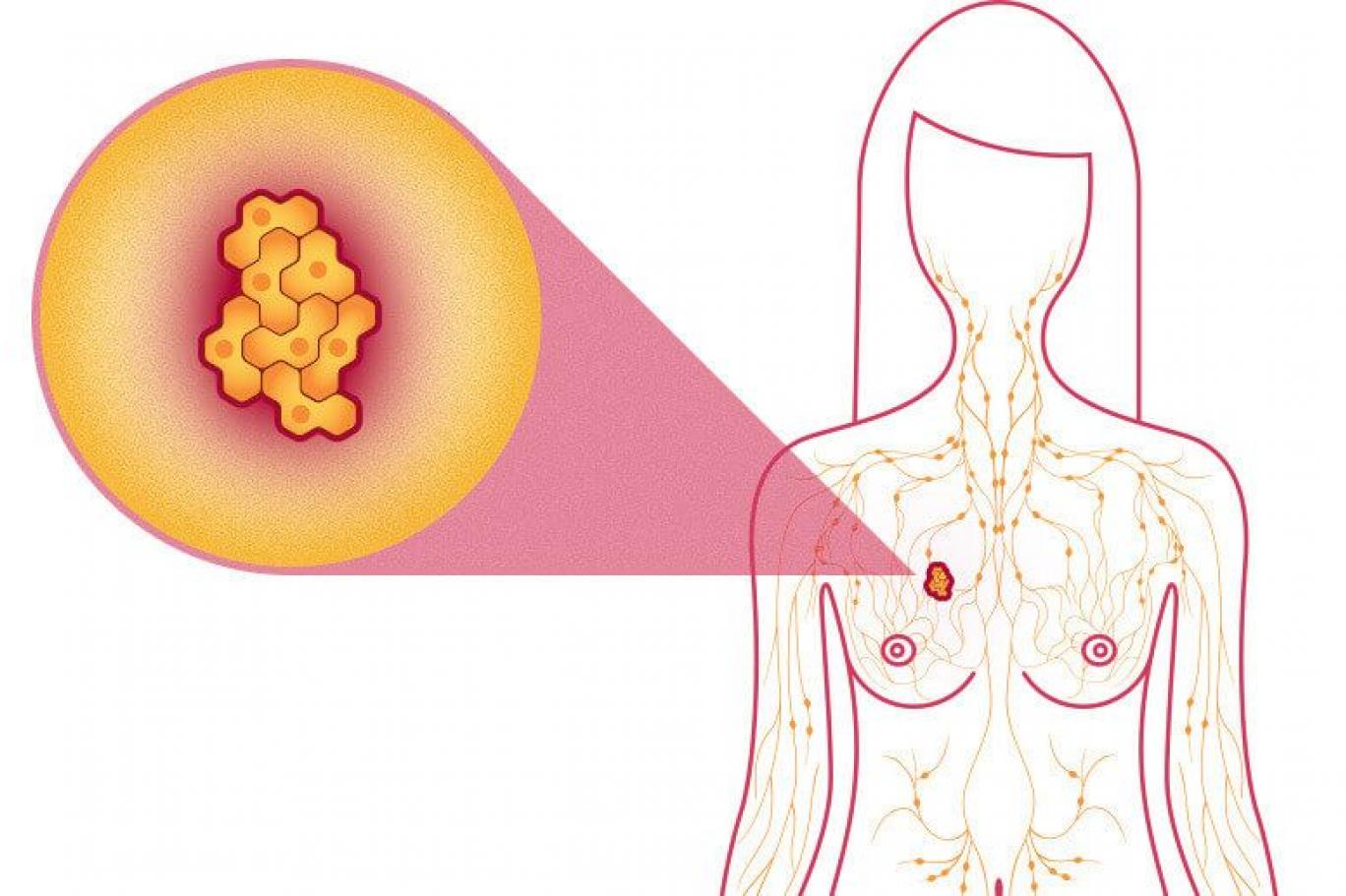 اعراض الورم الليفي في الثدي