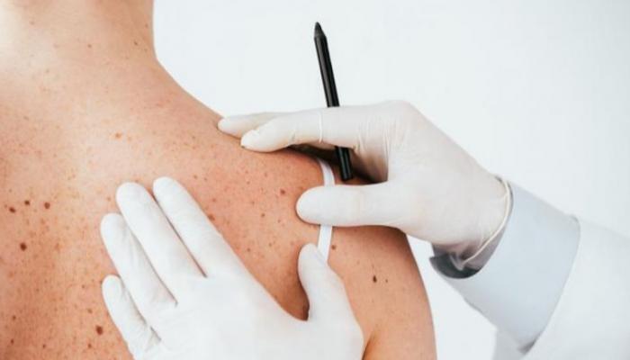 كم يعيش مريض سرطان الجلد ؟
