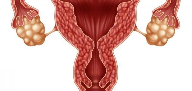 كيفية علاج تليف الرحم بالأعشاب