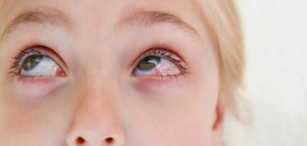 ما هي اعراض رمد العين؟
