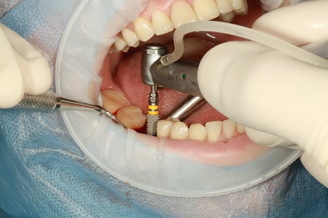 ما هي مخاطر زراعة الأسنان؟