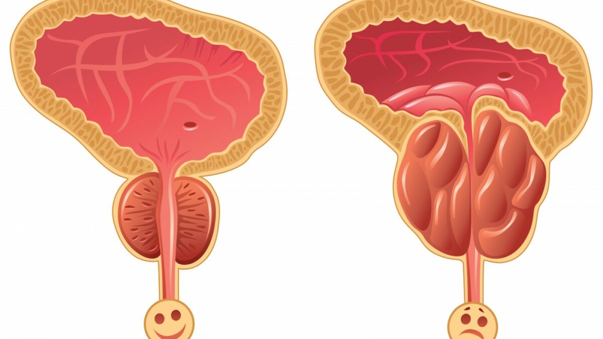 ما الفرق بين سرطان البروستاتا وتضخم البروستاتا؟