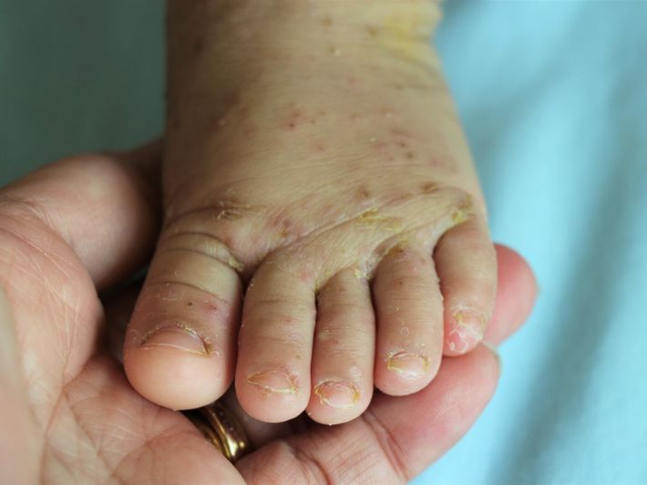 ما هو مرض اليد والقدم والفم عند الأطفال؟