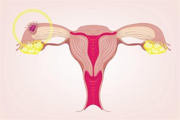 ما هي اسباب الحمل خارج الرحم؟