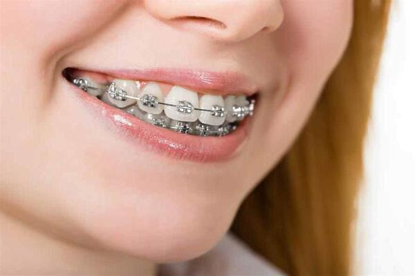 ما هي شروط تركيب تقويم الأسنان؟