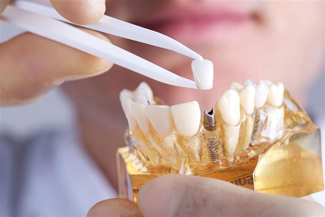 ما هي الممنوعات بعد زراعة الأسنان؟