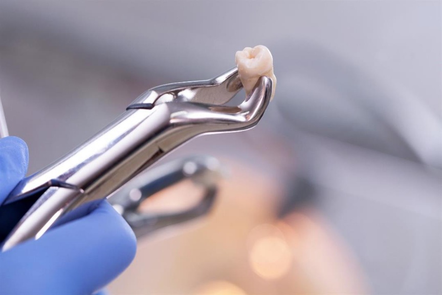 هل خلع الضرس يؤثر على باقي الأسنان؟